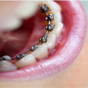Wingham Dental Practice - braces