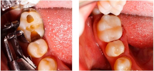 Wingham Dental Practice - fillings