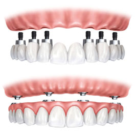 Wingham Dental Practice - implants
