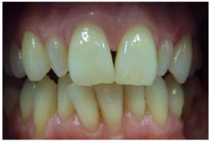 Wingham Dental Practice - veneers